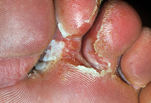 princ_rm_photo_of_athletes_foot_between_toes.jpg